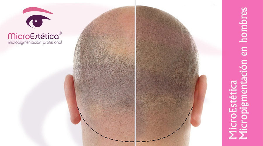 alopecia coronilla